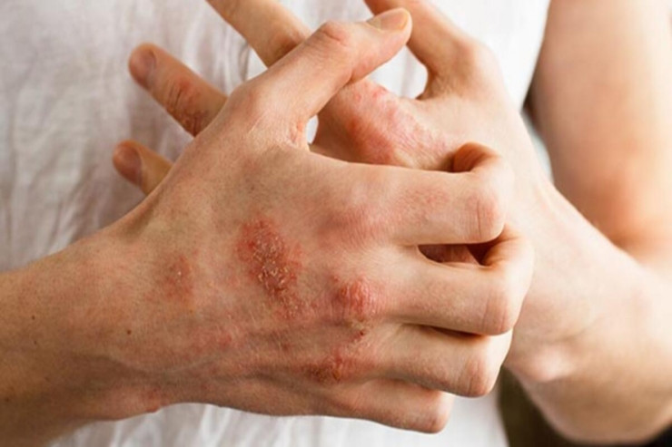 Allergiyanı azaldan və ya simptomlarını yüngülləşdirən QİDALAR