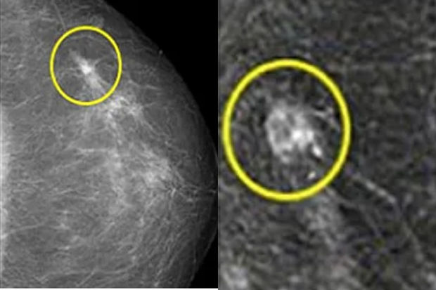 Onkoloq süd vəzisi xərçənginin əlamətlərini sadaladı