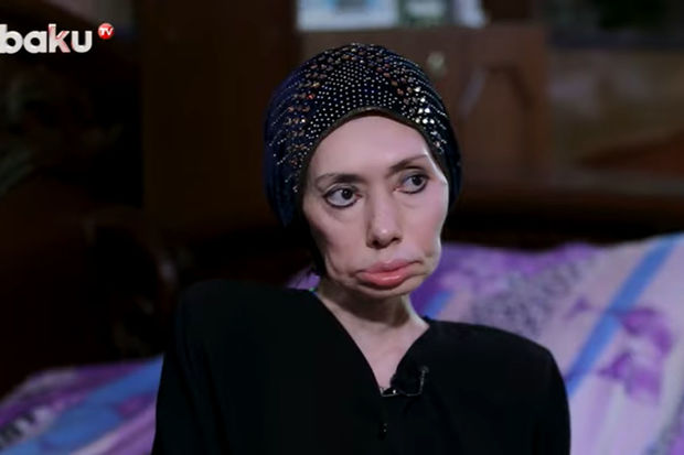Ayna Sultanovanın nəticəsi: “Erməni tibb bacısı məni əlil etdi” (VİDEO)