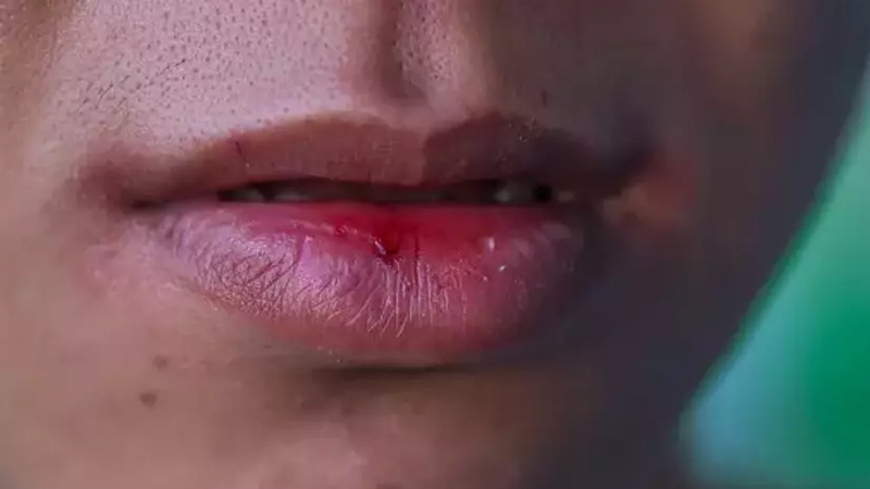 Əlləriniz və dodaqlarınız daim çatlayır? - Səbəb düşündüyünüzdən fərqli ola bilər