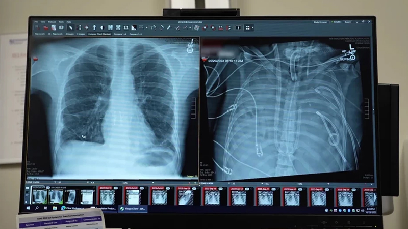 Tibbdə tarixi an: Xəstə ağciyərləri olmadan iki gün yaşadı