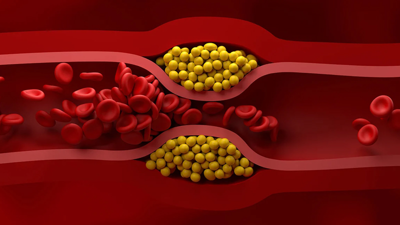 Xolesterin səviyyəsinə necə nəzarət etmək olar? - Kardioloqlardan yeni tövsiyələr