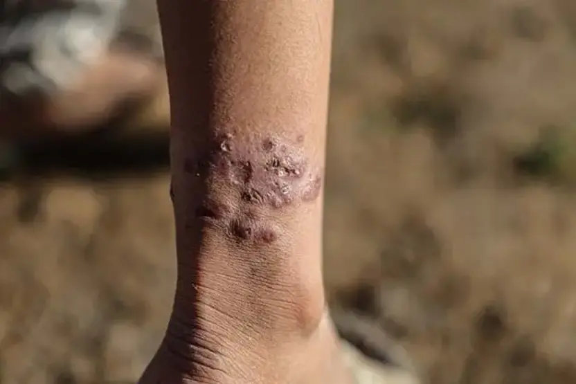 Suriyada qorxunc xəstəlik yayılır: Artıq 1500 nəfər yoluxub (FOTO)