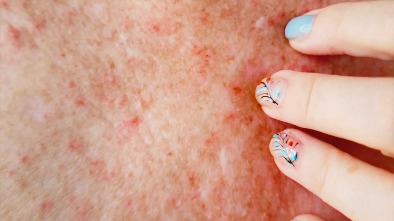 Yayda səpkilərdən necə qurtulmaq olar? - Dermatoloqdan sadə tövsiyə