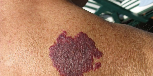 Doğum ləkəsi qorxuludurmu?