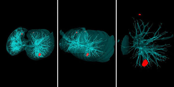Xərçəngi 20 saniyədə müəyyənləşdirməyin yolu tapıldı