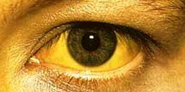 Jilbert sindromu nədir?