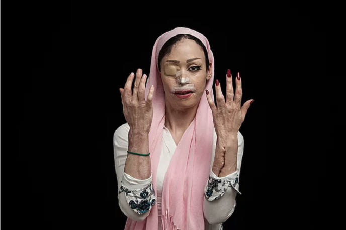 Üzünə “kislota” tökülən qadınlar – İranda (fotolar)