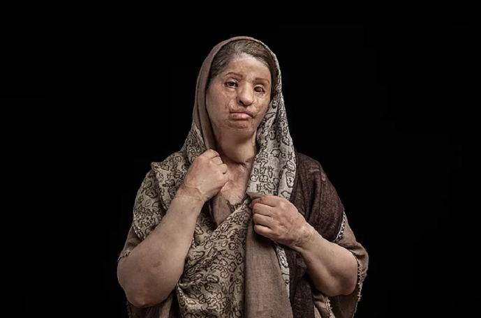 Üzünə “kislota” tökülən qadınlar – İranda (fotolar)