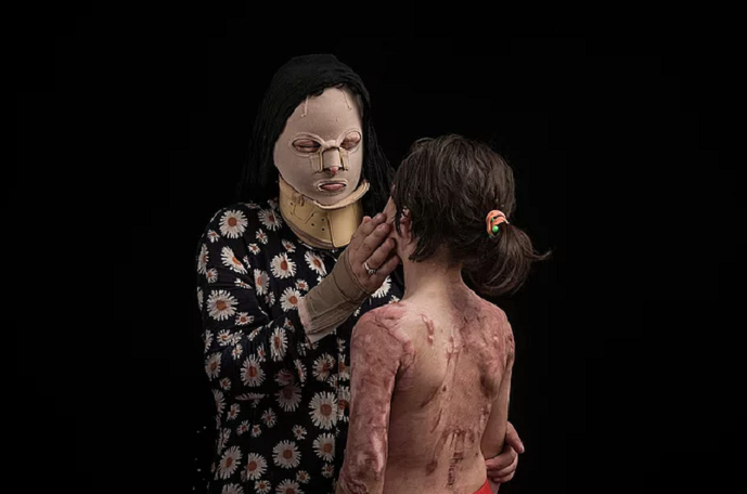 Üzünə “kislota” tökülən qadınlar – İranda (fotolar)