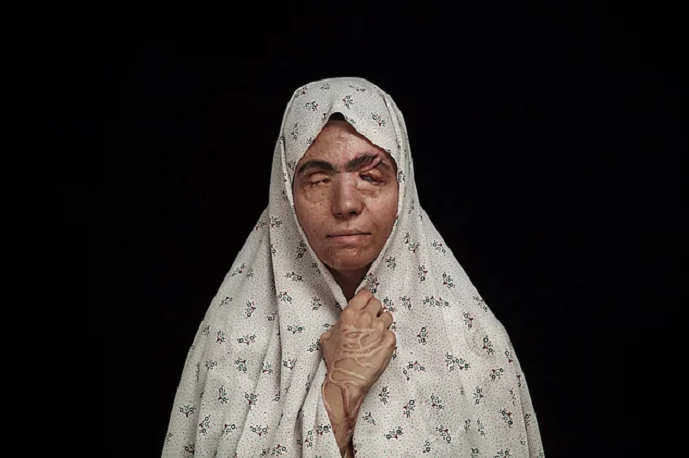 Üzünə “kislota” tökülən qadınlar – İranda (fotolar)
