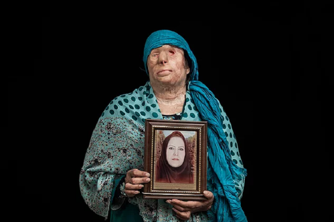 Üzünə “kislota” tökülən qadınlar – İranda (fotolar)