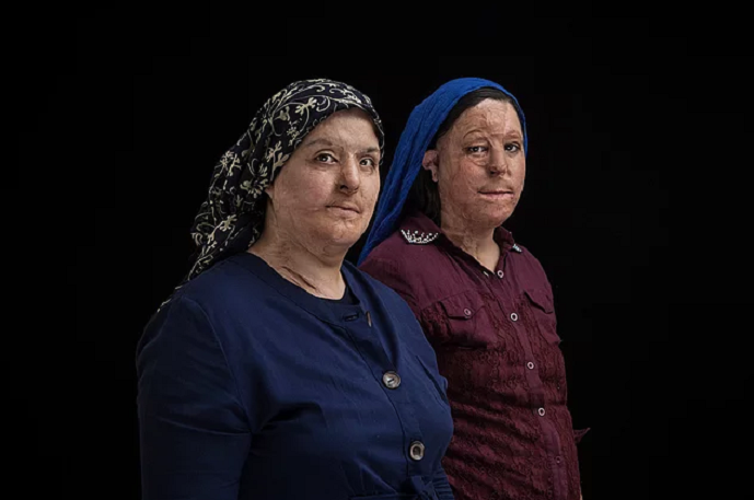 Üzünə “kislota” tökülən qadınlar – İranda (fotolar)