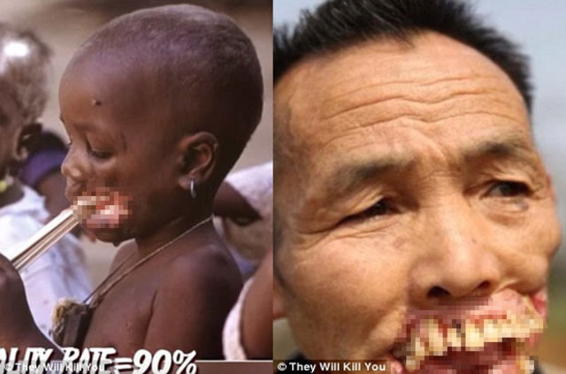Dünyada ən qorxunc — 10 xəstəlik