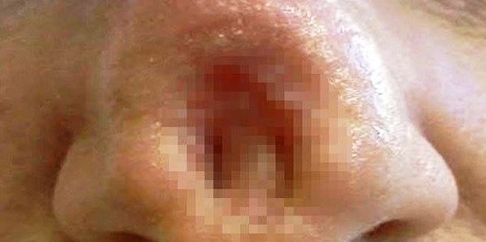 Saxta xərçəng dərmanı burnunda dəlik açdı - FOTOLAR