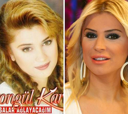 Estetik əməliyyatla dəyişilən türk MƏŞHURLARI - FOTOLAR