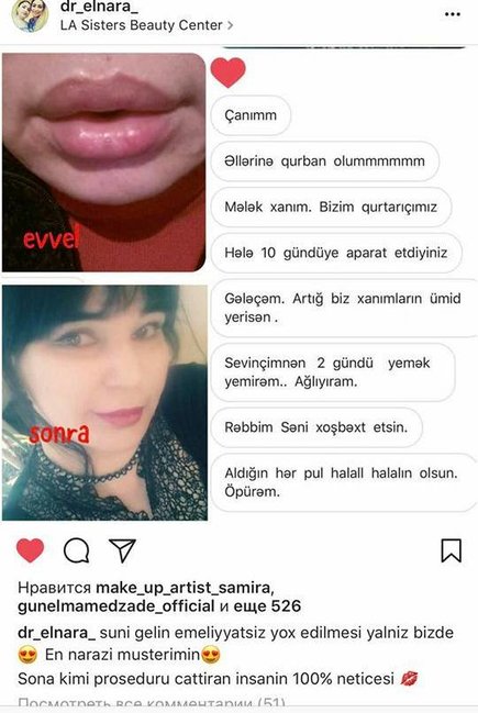 Azərbaycanlı həkim-kosmetoloq dodaqları məhv olan Merveni YENİDƏN HƏYATA QAYTARDI – VİDEO - FOTOLAR