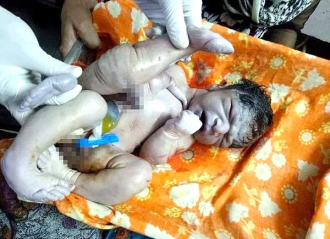 İki cinsi orqanla doğulan körpəni quyuya atmaq istədilər - "Şeytan kimi doğuldu"