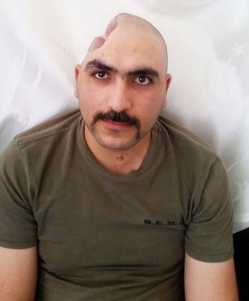 Aprel döyüşündə yaralanan hərbçiyə süni kəllə qapağı qoyuldu