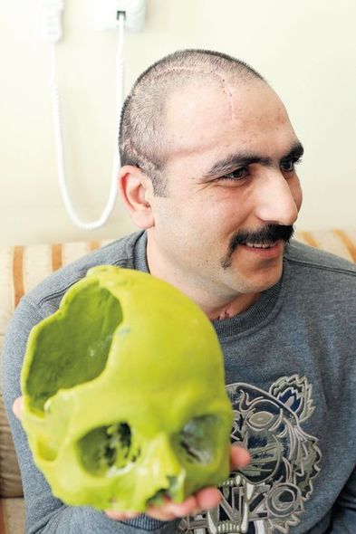 Aprel döyüşündə yaralanan hərbçiyə süni kəllə qapağı qoyuldu