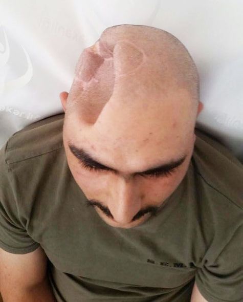 Aprel döyüşündə yaralanan hərbçiyə süni kəllə qapağı qoyuldu