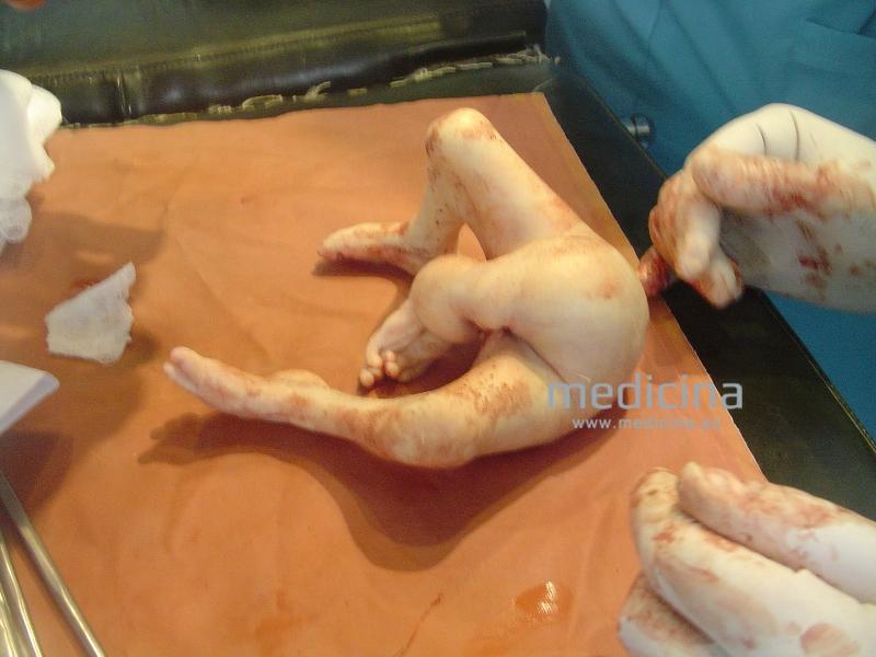 Azərbaycanda 4 əlli, 4 ayaqlı uşaq doğuldu - ƏSƏBİ ZƏİF OLANLAR BAXMASIN - FOTOLAR