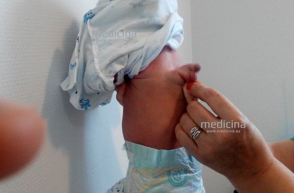Azərbaycanda uşaq kürəyində cinsiyyət orqanı ilə doğuldu – FOTO