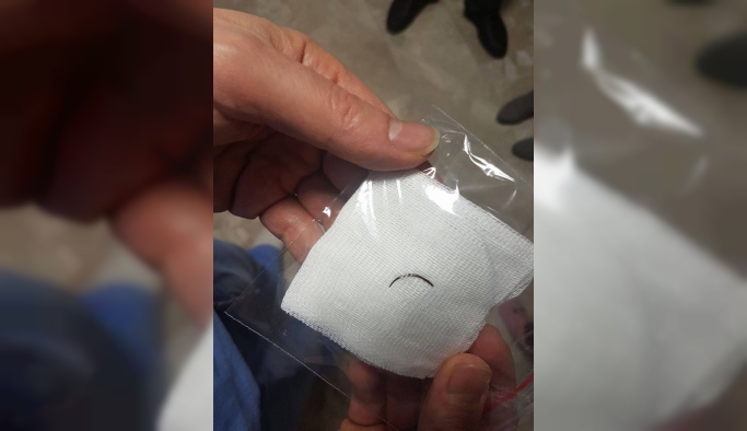 Boğazındakı iynə 19 il sonra çıxarıldı - Fotolar