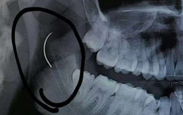 Boğazındakı iynə 19 il sonra çıxarıldı - Fotolar