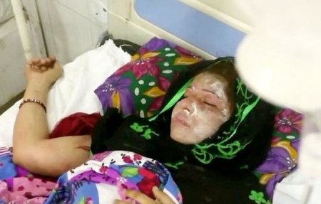 Ər 3-cü dəfə qız doğan arvadının üzünə "kislota" atdı - FOTO