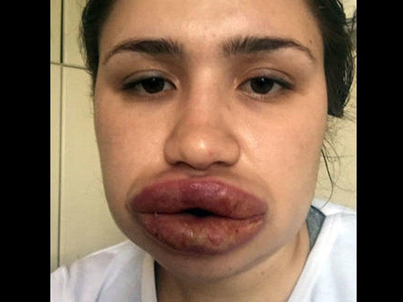 Həkimin dəhşətli vəziyyətə saldığı qız sağaldı - FOTO