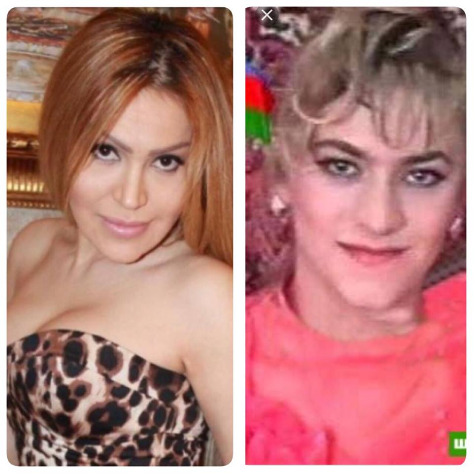 Məşhurlarımızın estetik əməliyyatdan əvvəlki halları - FOTOLAR