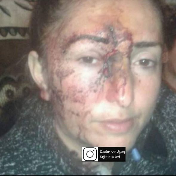 Şəmkirdə ər arvadını içki şüşəsi ilə vəhşicəsinə döydü - FOTO