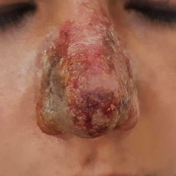 Azərbaycanda dəhşət: Kosmetoloq qızın burnunu inanılmaz hala saldı – Fotolar (18+)