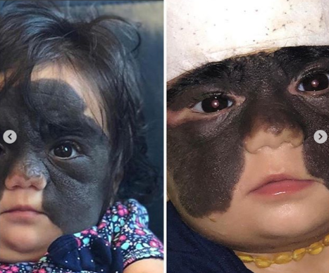 "Betman maska"lı amerikalı uşaq Rusiyada əməliyyat olunduqdan sonra - FOTO-VİDEO