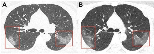 Koronavirus insanın ağciyərlərini bu hala salır - FOTO