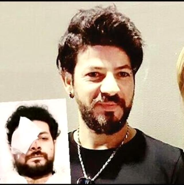 Türkiyəli müğənni gözündən güllələndi – FOTOLAR