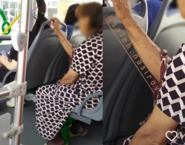 Azərbaycanda meymunçiçəyinə yoluxan şəxs var? - Avtobusda şok FOTO