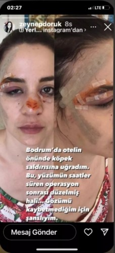 Türkiyəli aktrisanın üzünü it parçaladı - FOTOLAR