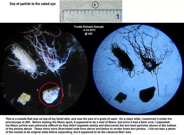 Dərinin altında həşərat hissi yaradan və müalicəsi mümkün olmayan xəstəlik - Morgellons simptomu