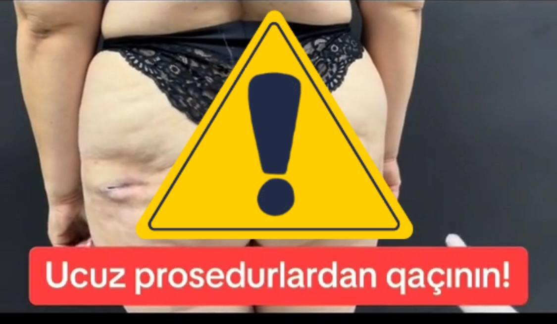 Bakıda ombadikləşdirmə əməliyyatı etdirən qadının bədəni yırtıldı - Bu hala düşdü - FOTO + VİDEO